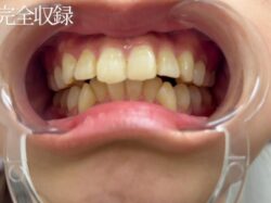 【素人・口腔フェチ】裏側矯正＋美女素人高身長ラウンドガール18歳。高額オファーでガチ交渉。検診記録を初公開。